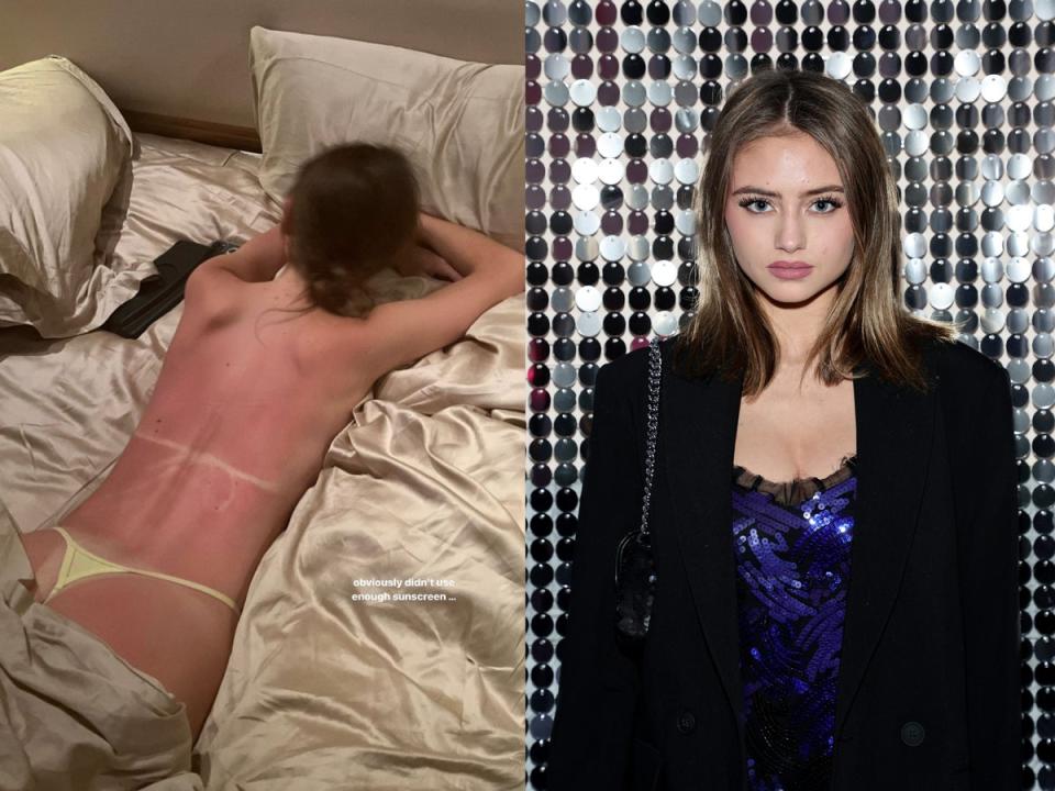 Model Leni Klum shows off her sunburn on Instagram (Instagram @leniklum)
