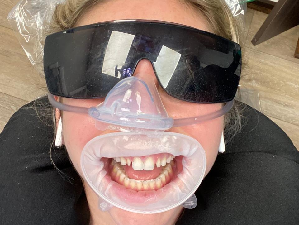 Grace Fewell lying back in a dentists office with a pair of black safety glasses on, a mask over her nose, and her mouth held open with a silicone mouthpiece.