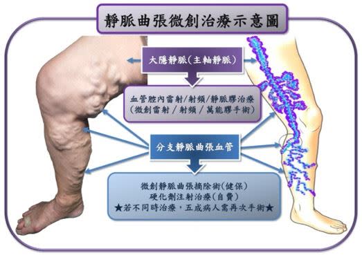 林哲安醫師說明靜脈曲張微創治療示意圖。（圖／天晟醫院提供）