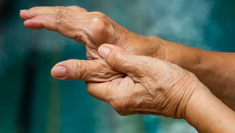 A clinical trial found abatacept “effective in preventing the onset” of rheumatoid arthritis.