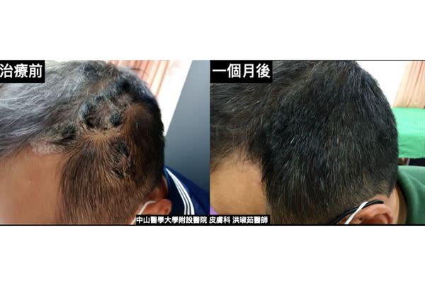 個案何先生治療前及治療一個月後頭皮狀況比對圖。（圖片／中山醫學大學附設醫院皮膚科洪琡茹醫師提供）