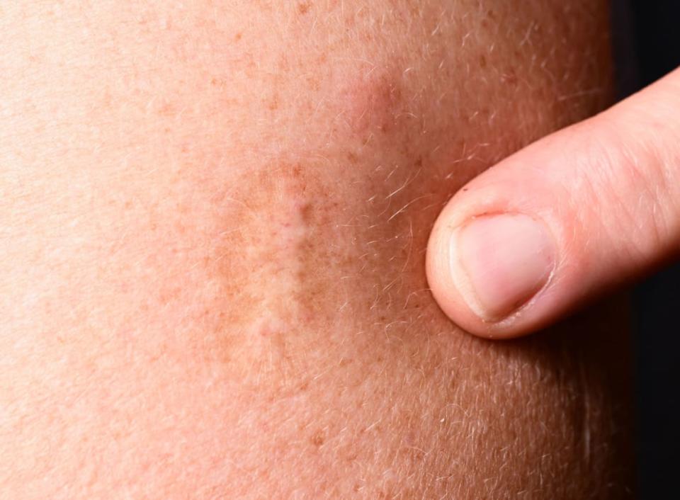 <div class="inline-image__caption"> <p>A scar from a smallpox vaccination is visible on an upper arm. There is no approved vaccination specifically against monkeypox. According to historical data, however, a smallpox vaccination provides good protection against monkeypox - and probably for life.</p> </div> <div class="inline-image__credit"> Photo by Bernd Weißbrod/picture alliance via Getty Images </div>