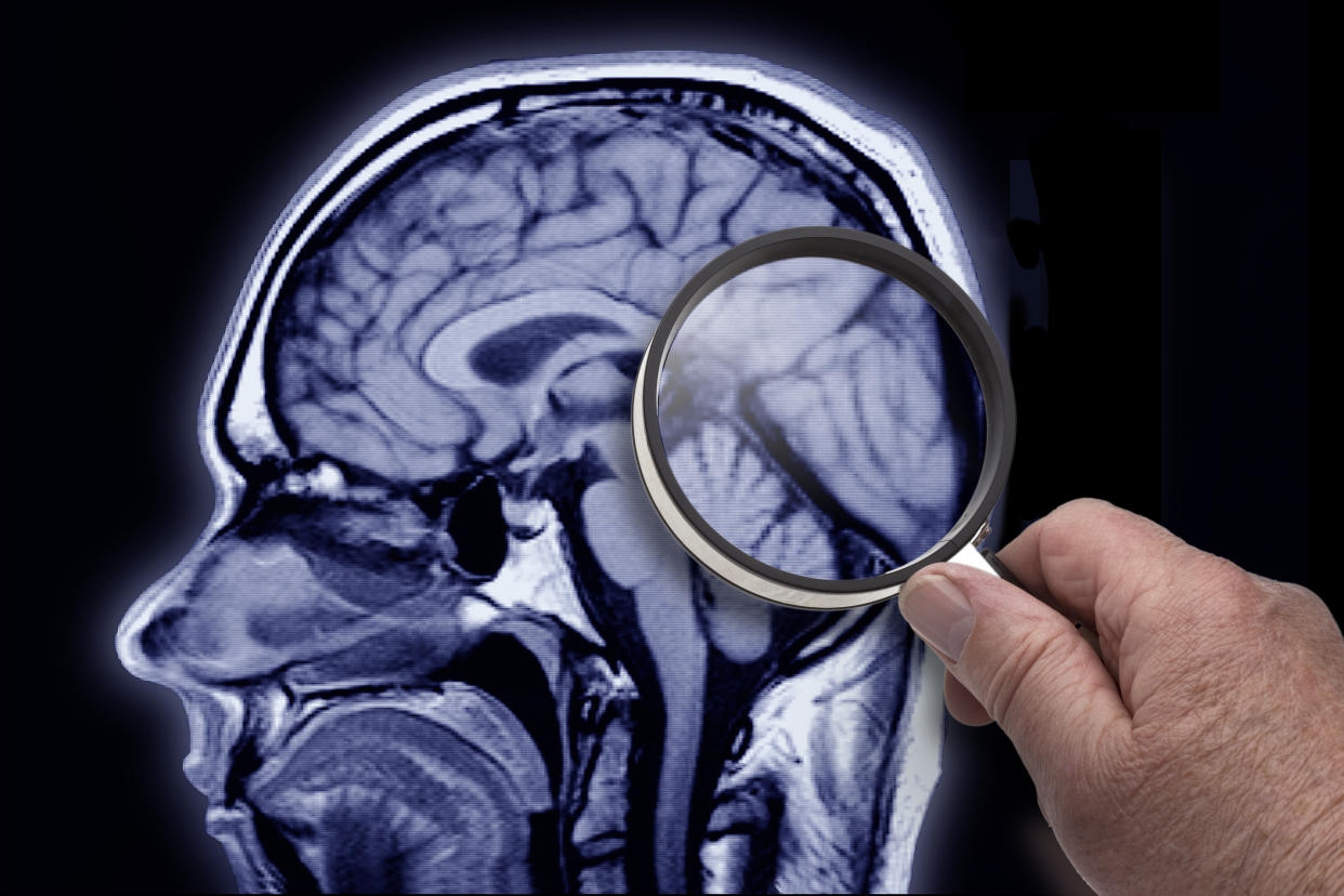 A hand holding a magnifying glass over an MRI scan of the brain of a patient with Alzheimer's disease.