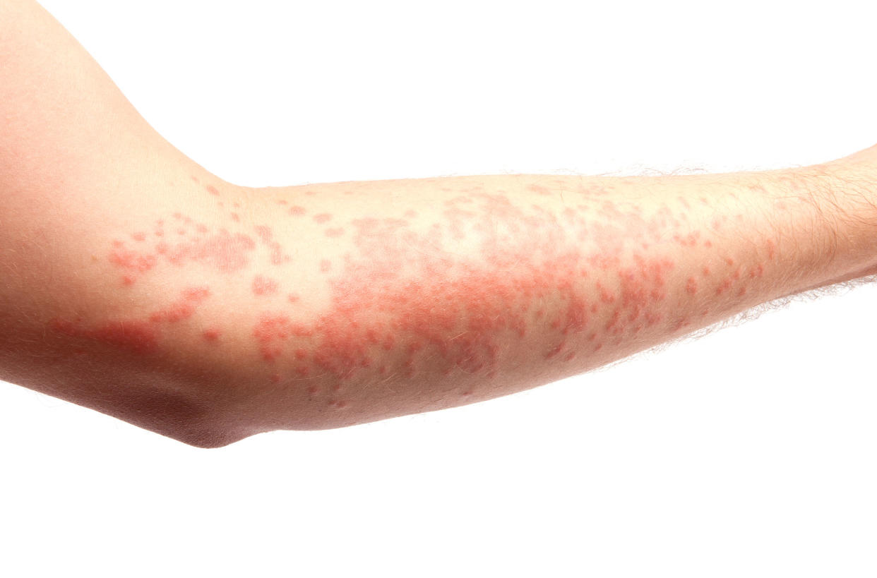 Photos of eczema skin condition and what causes eczema (gokhanilgaz / Getty Images)