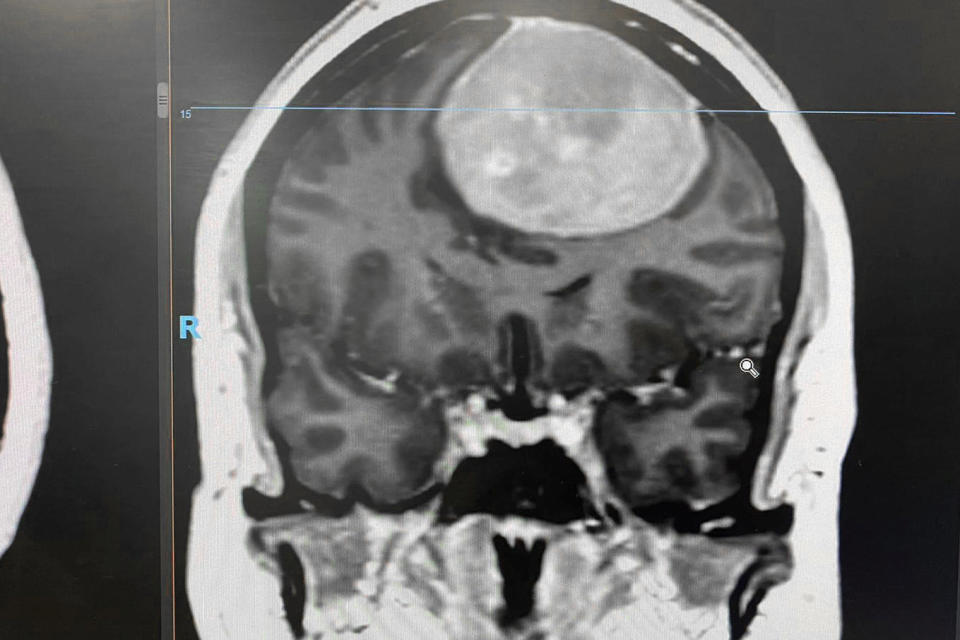 An MRI scan revealed tennis ball sized tumour on Green's brain. (Helen Green/SWNS)
