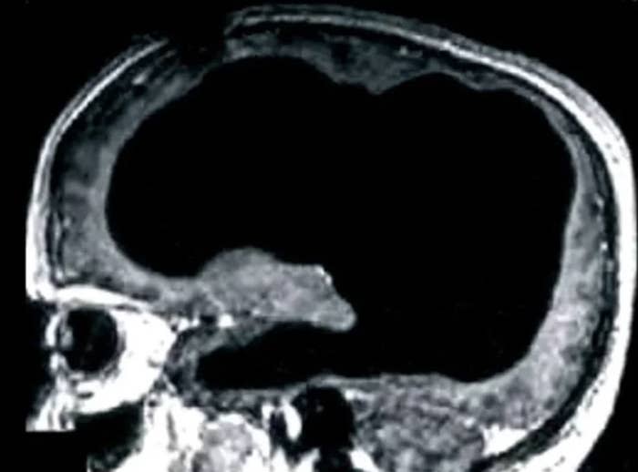 MRI scan of a human brain showing a large dark area that likely represents a significant cavity or abnormality