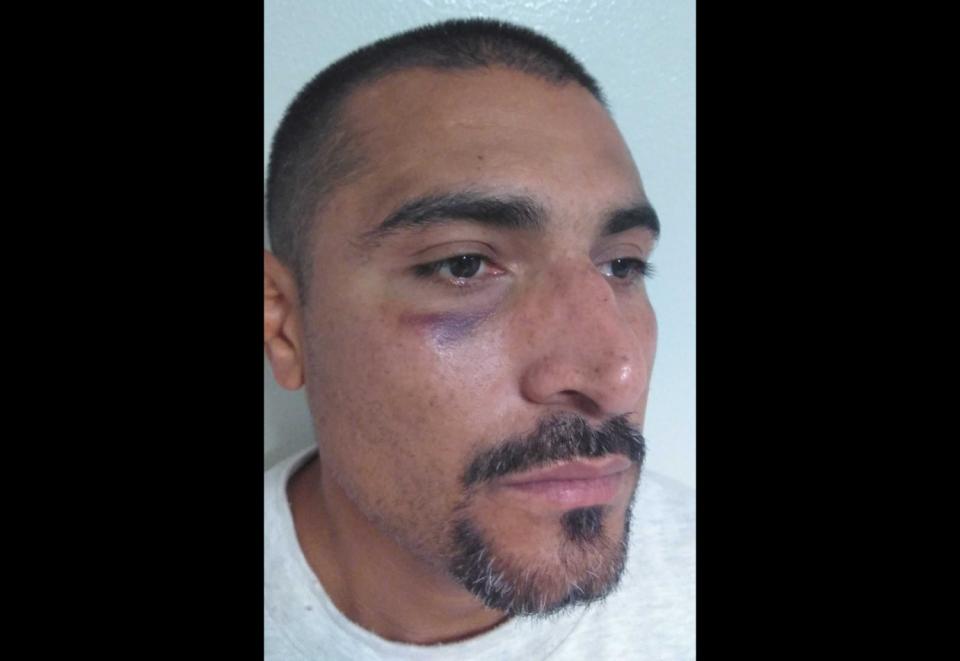 A man with bruising under and around his right eye