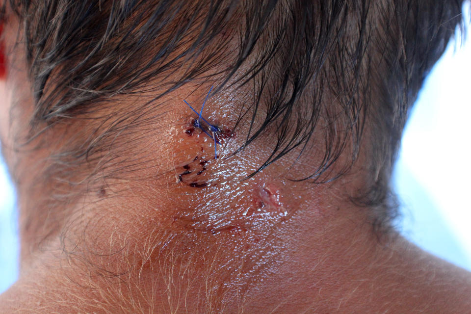 In this photo provided on Monday, April 22, 2013, French fisherman Yoann Galeran displays a cut to his neck while on board the FV Ruby in Gove Harbour, near Nhulunbuy, Australia. Galeran, 29, said he was swimming from shore to a dinghy about 15 meters (50 feet) away on Sunday night when a crocodile between 2 meters (6 feet 7 inches) and 2.5 meters (8 feet 2 inches) clamped down on his head and neck and attempted to drown him in a maneuver known as a death roll. (AP Photo/Lisa Heathcote, HO) EDITORIAL USE ONLY