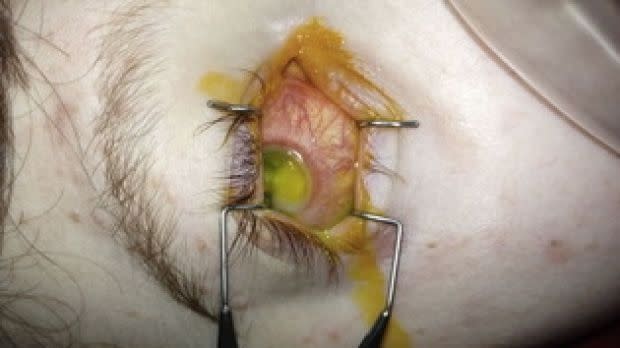 This is the eye of a 14-year-old suffering from Vitamin A deficiency. Photo: Medical Journal of Australia