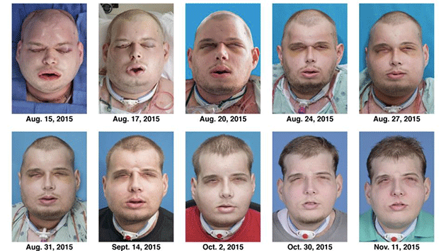 This is the recuperation of Patrick Hardison after his facial transplant surgery in New York after he was burned after entering a burning house to search for a woman. Photo: NYU Langone Medical Centre via AP