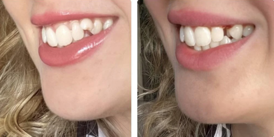 Two side-by-side close-up images of the same person showing a dental transformation with straighter teeth