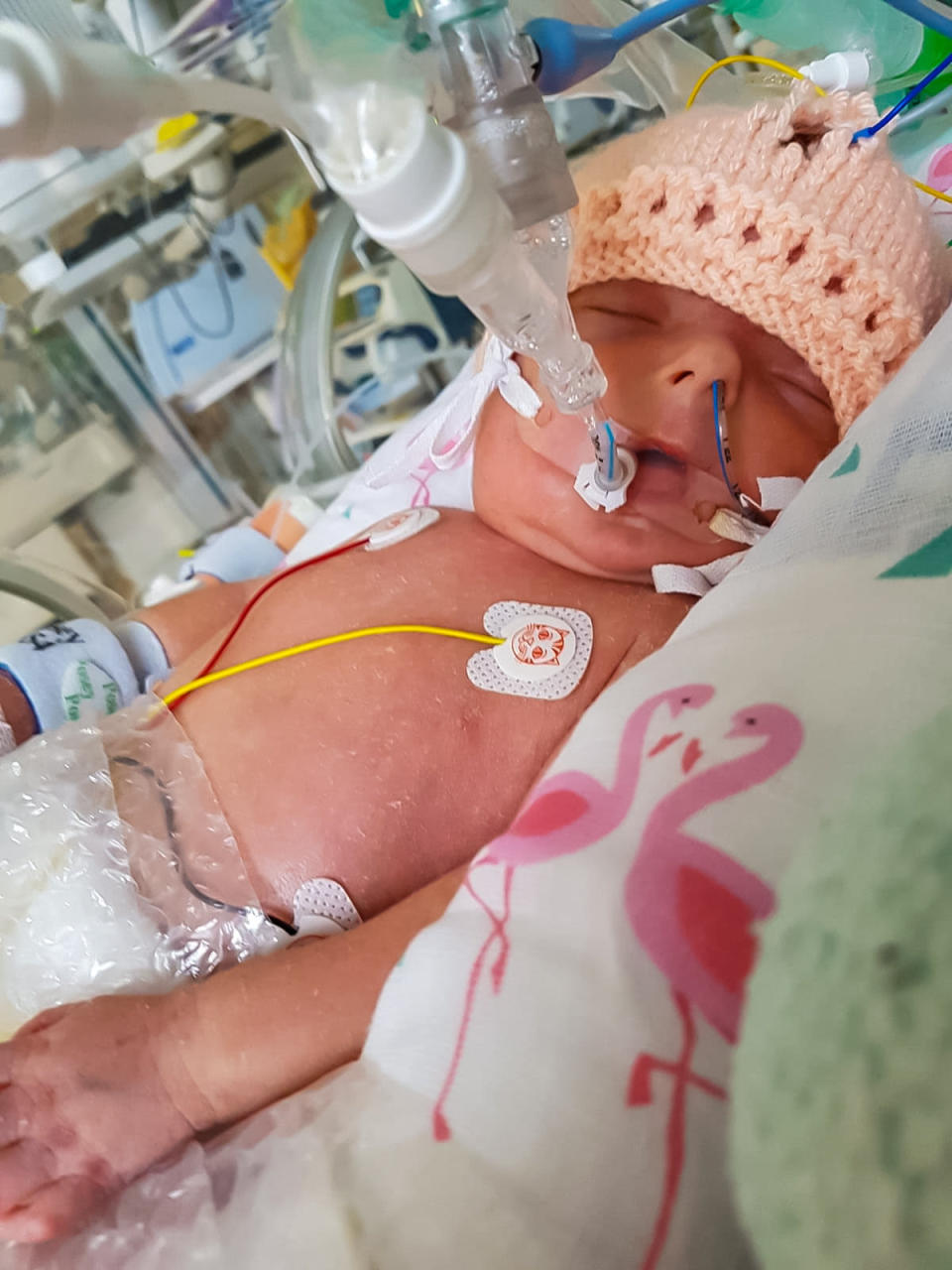 Isla was put in an induced coma for the first five days of her life. (Photo: SWNS)