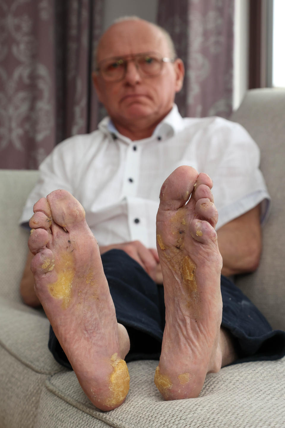 Bentley, 63, has a rare genetic disorder that causes thickening of the skin on the soles of his feet. (SWNS)