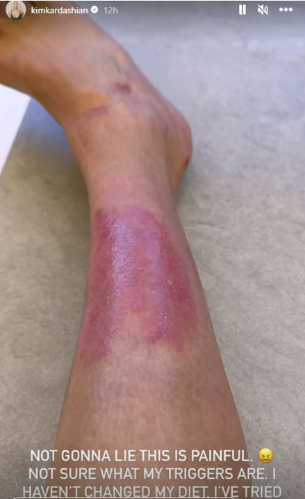 Kim Kardashian shares photos of her psoriasis on Instagram.