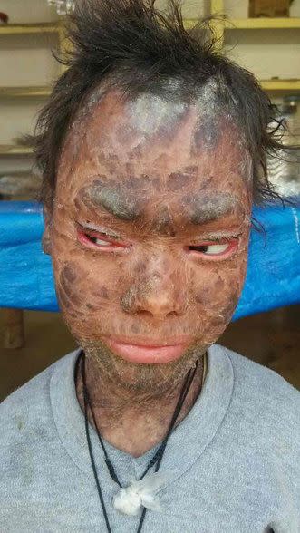 Serpiente humana: Shalini sufre un trastorno cutáneo muy extraño que le hace mudar su piel cada dos meses (Imágenes: SWNS)