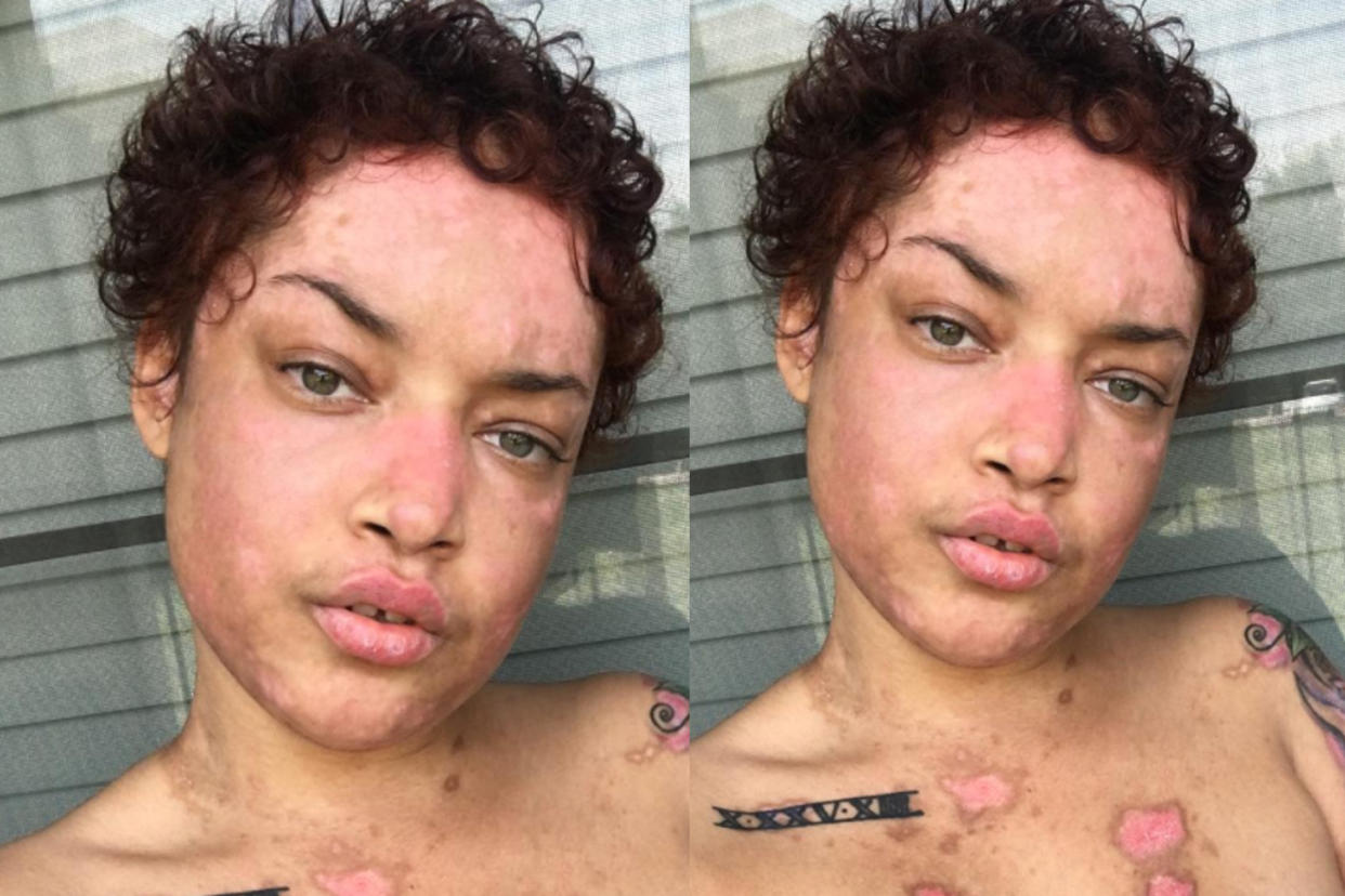 Instagrammer Jokiva Bellard, who has lupus, shares selfies to raise awareness about the condition. (Photo: Jokiva Bellard via Instagram)