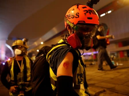 A member of the press shows a bruise, after a march to call for democratic reforms in Hong Kong