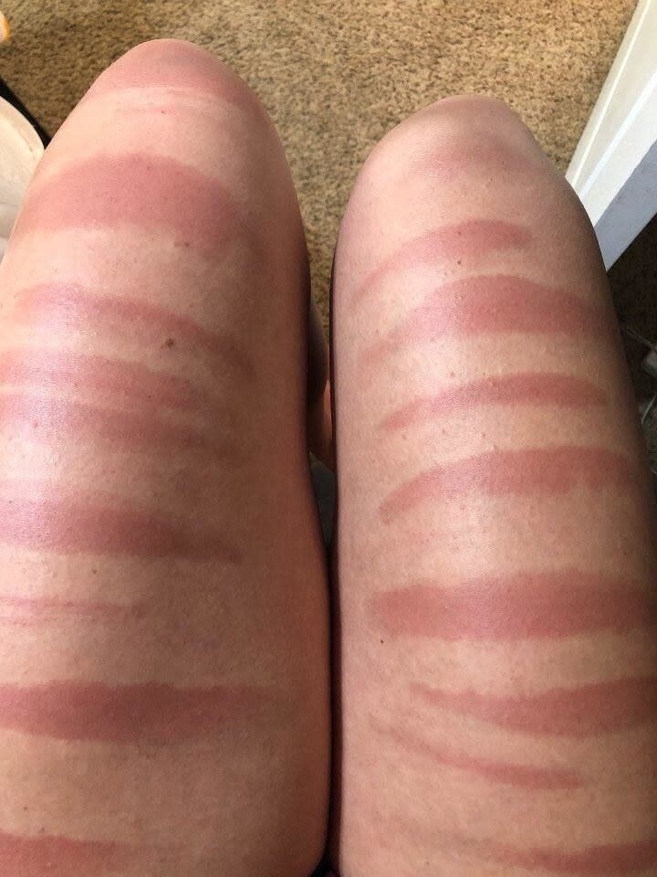 Sunburn on someone's thighs