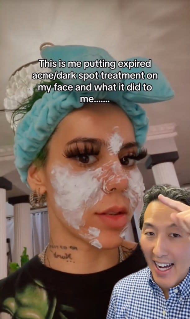 A content creator named BeastEater used expired acne and dark spot treatment on her face and developed an infection. TikTok/@doctoryoun/@BeastEater