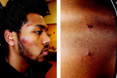 Photos taken after Sterling Brown's arrest show&nbsp;abrasions to his face and puncture wounds to his back. (Photo: Gingras Cates and Wachs)