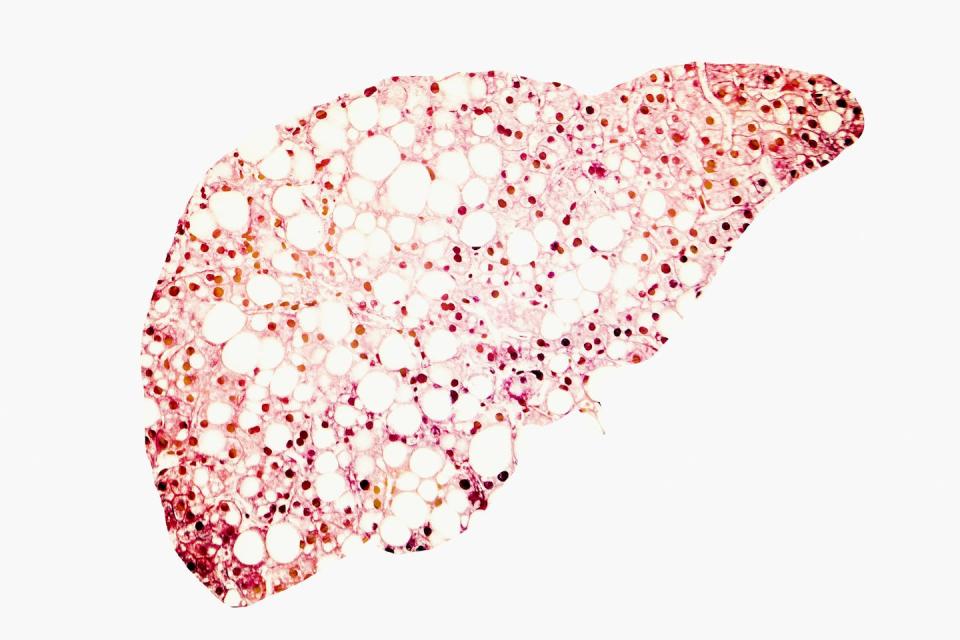 Left untreated, fatty liver disease can lead to severe damage. <a href="https://www.gettyimages.com/detail/illustration/fatty-liver-conceptual-illustration-royalty-free-illustration/932736606" rel="nofollow noopener" target="_blank" data-ylk="slk:Kathryn Kon/Science Photo Library via Getty Images;elm:context_link;itc:0;sec:content-canvas" class="link ">Kathryn Kon/Science Photo Library via Getty Images</a>
