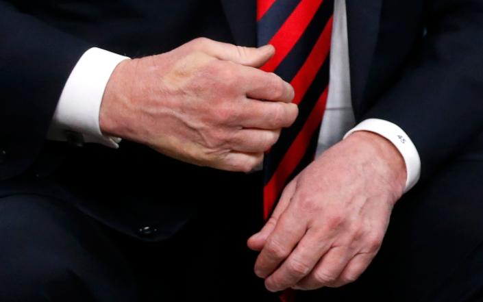 The imprint of French President Emmanuel Macron&#39;s thumb can be seen across the back of President Trump&#39;s hand after a handshake during a bilateral meeting at the G7 Summit in Canada on June 8, 2018.