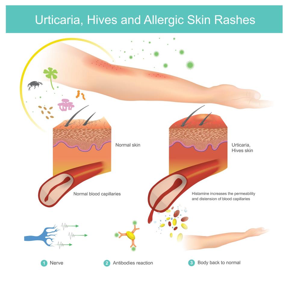 An immune reaction to an allergen causes bumps and itchiness during an outbreak of hives. <a href="https://www.gettyimages.com/detail/illustration/urticaria-hives-and-allergic-skin-rashes-royalty-free-illustration/936276140?adppopup=true" rel="nofollow noopener" target="_blank" data-ylk="slk:Graphic_BKK1979/ iStock via Getty Images;elm:context_link;itc:0;sec:content-canvas" class="link ">Graphic_BKK1979/ iStock via Getty Images</a>