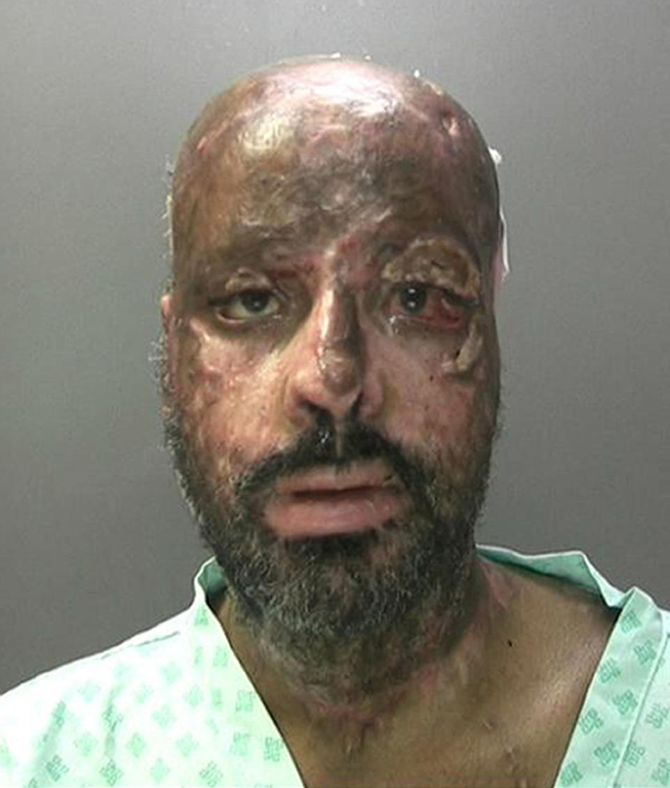Endris Mohammed suffered horrific burns after setting fire to his family home