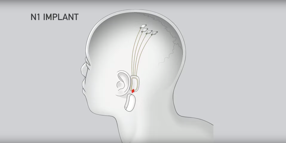 Der Chip sitzt hinter dem Ohr, während die Elektroden in das Gehirn eingeführt werden. - Copyright: Neuralink/YouTube