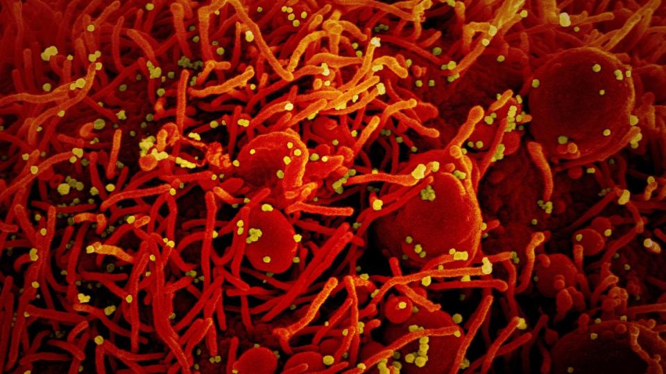 Auf dieser vom US-Forschungszentrum «National Institute of Allergy and Infectious Diseases» (NIAID) zur Verfügung gestellten Aufnahme ist eine Zelle (rot) mit dem Coronavirus (SARS-CoV-2, gelb) infiziert.