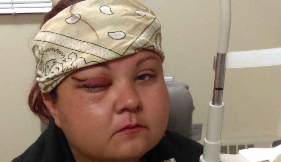 vanessa-dundon standing rock protester hit in face