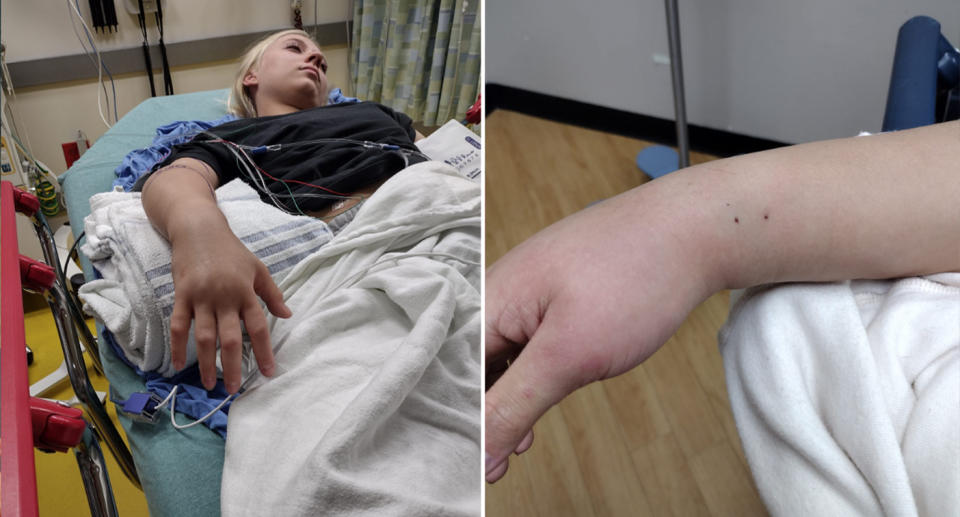 The teen in hospital with a swollen arm and the two fang holes in her wrist. 