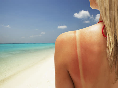 <div class="caption-credit"> Photo by: Getty</div><div class="caption-title">Serious Sunburn</div>Your fresh-from-the-island glow has morphed into a lobster-like burn. <br> <b><br> CHILL OUT</b> Take an over-the-counter anti-inflammatory like aspirin or ibuprofen, apply a cool compress soaked in equal parts milk and water, and dab on a 1 percent hydrocortisone cream to calm inflammation fast, advises NYC dermatologist Dr. Heidi Waldorf. <br> <b><br> COVER UP</b> If staying locked up for a few days isn't an option--say you've got an event to attend or, even more distressing, a job interview--celebrity makeup artist Andrew Sotomayor suggests camouflaging redness with a creamy, yellow-based liquid concealer to help minimize the look of dry, peeling skin. Just "moisturize like crazy" before you apply, says Miami-based derm Dr. Joely Kaufman-Janette, who also recommends using a green-tinted primer. Visit <br>