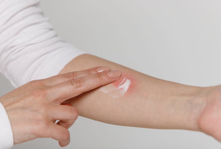 <span class="caption">The cream is already on the market.</span> <span class="attribution"><a class="link " href="https://www.shutterstock.com/image-photo/allergic-reaction-itch-dermatitis-woman-applying-1429765838" rel="nofollow noopener" target="_blank" data-ylk="slk:DimaBerlin/ Shutterstock;elm:context_link;itc:0;sec:content-canvas">DimaBerlin/ Shutterstock</a></span>