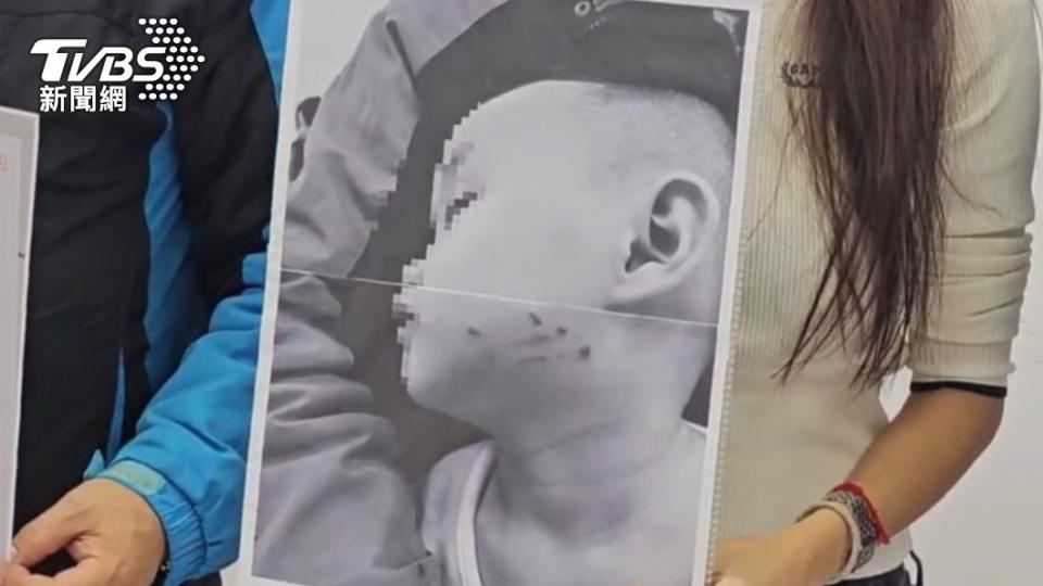 男童被臉頰被蔡老師抓破皮。（圖／TVBS）