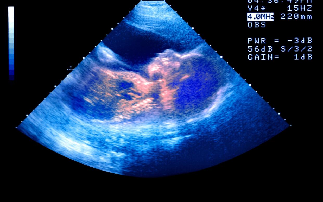 In England, Scotland and Wales, abortion is legal up to 24 weeks with the approval of two doctors