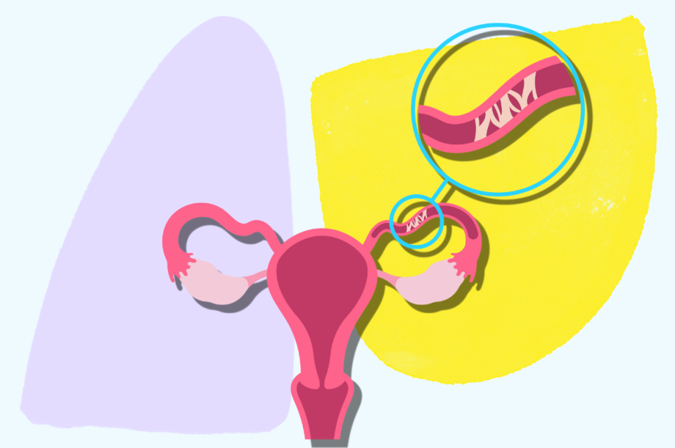 Yahoo Canada checked in with a gynecologist on what it means to have a blocked fallopian tube. (Canva)