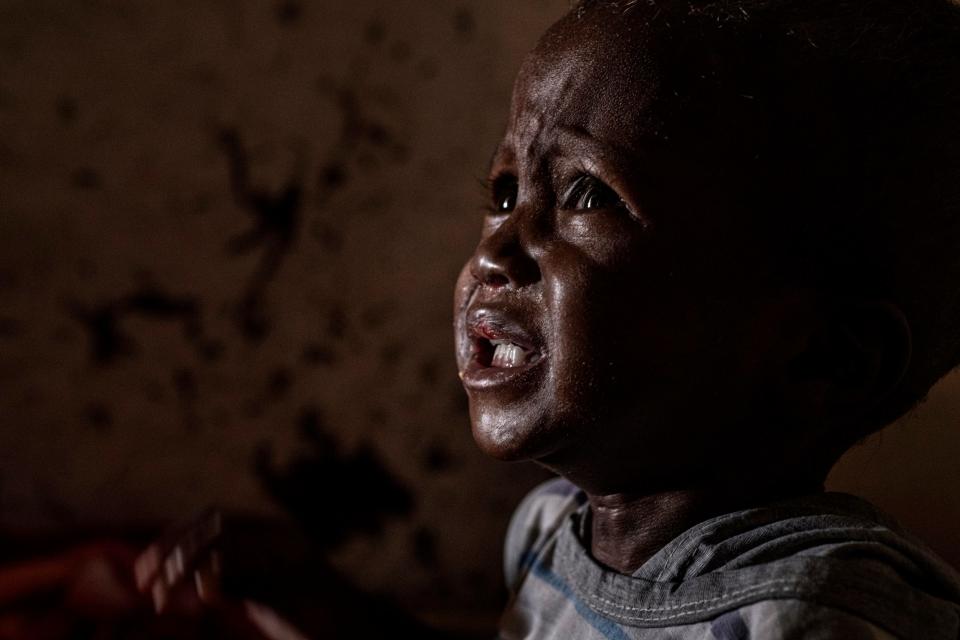 Malnourished Ibrahim, aged two, weighed only a third of what he should when he arrived at the clinic - Simon Townsley/The Telegraph