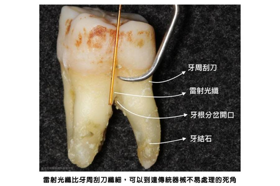 【有影】新式水雷射輔助牙周治療和傳統牙周刮刀治療有何差異？專科醫師結合高科技儀器 看病不必再驚慌 205