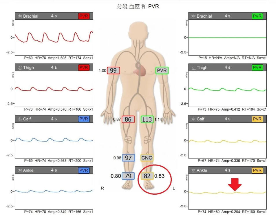 <strong>患者左腳踝ABI值偏低，且脈搏明顯偏弱，是周邊動脈阻塞症狀之一。（圖／亞大醫院提供）</strong>