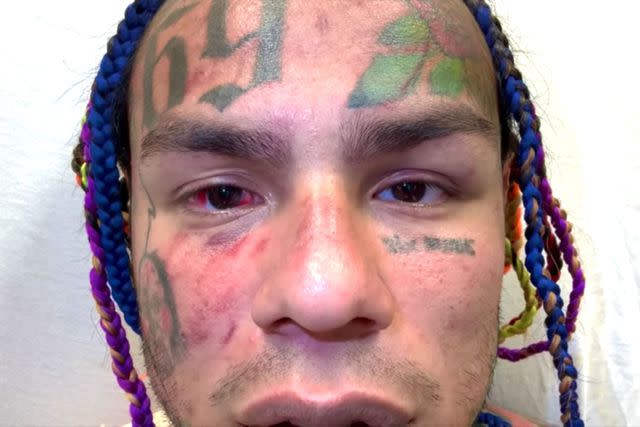 Tekashi 6ix9ine Tekashi 6ix9ine shows off his injuries from a march attack at a gym