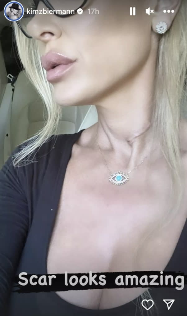 Kim Zolciak Shows Off Neck Scar After She Underwent Surgery for Herniated Disc: ‘Looks Amazing’