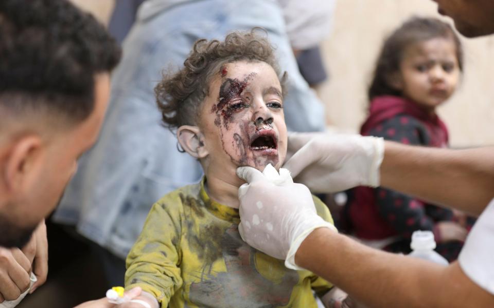 Palestinian children wounded in the Israeli bombardment of the Gaza Strip are treated at al Aqsa Hospital on Deir al Balah