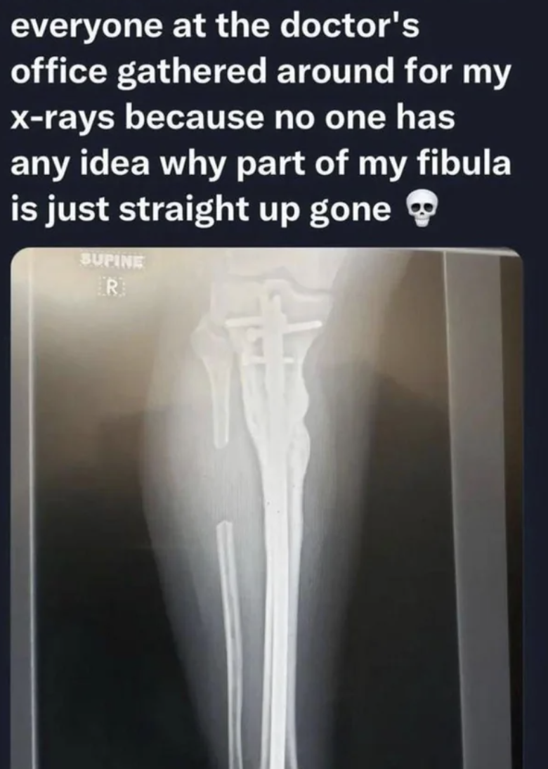 X-ray showing a missing section of the fibula bone, generating interest at the doctor's office