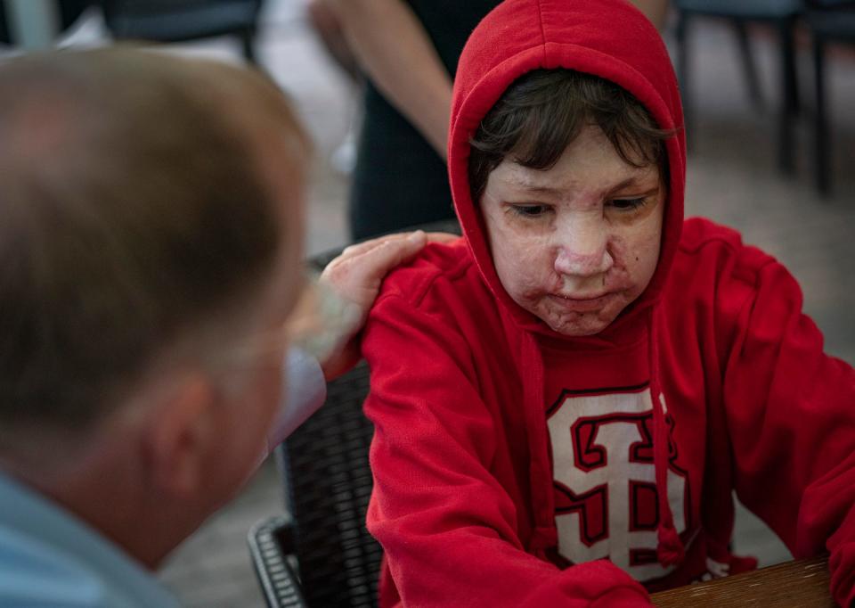 Maksim Kondrashov, 13, is screened for surgery on his arms by Doctors Collaborating to Help Children at a hotel he is staying at in Leczna, Poland, Sunday, May 14, 2023. Kodrashov was severely burned in hotel fire.