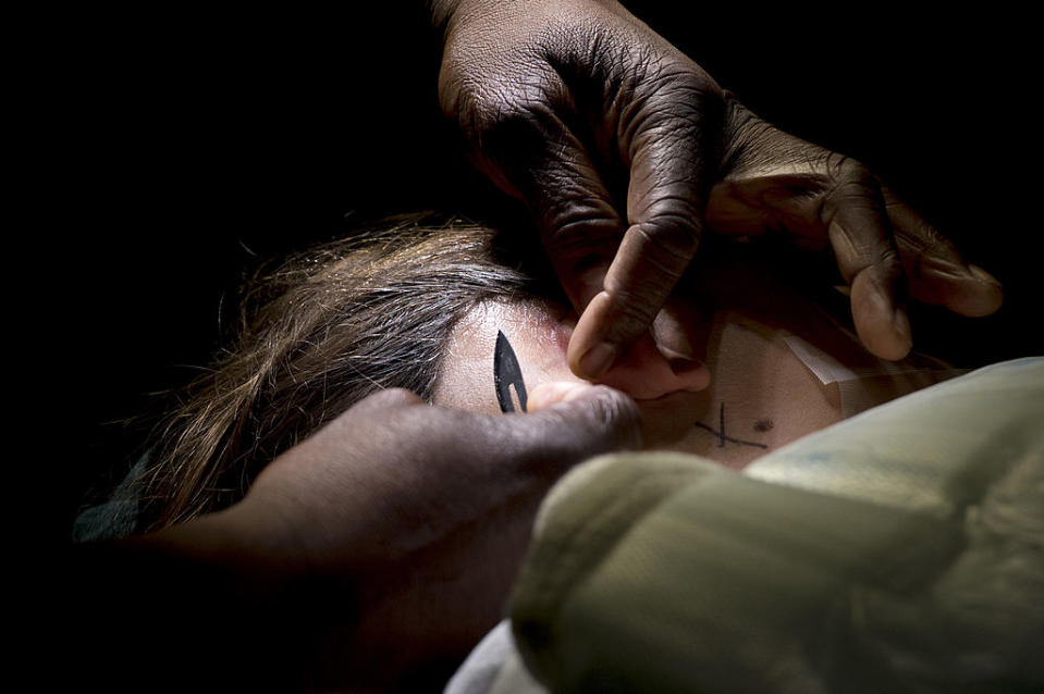 Child receives cochlear implant. Source: Getty