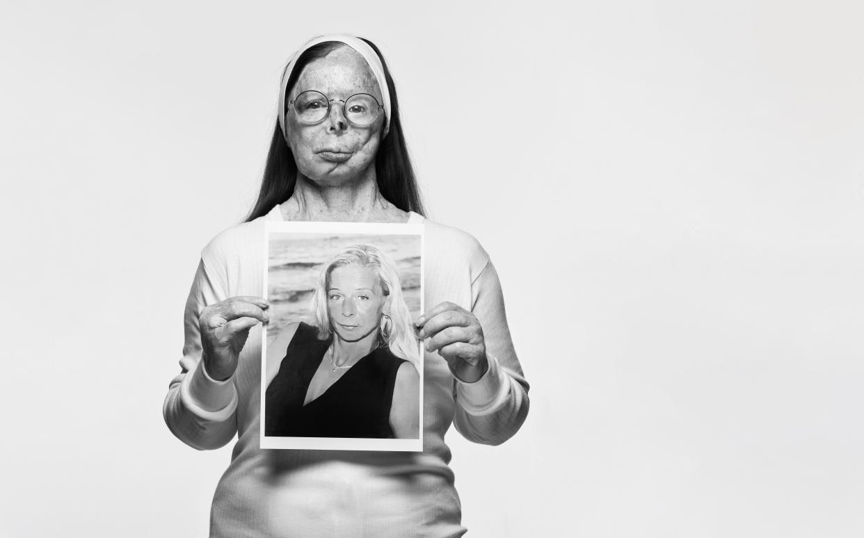  Black and white photo of acid attack survivor Patricia Lefranc, holding a photo of her taken before she was attacked, photographed by Rankin for the Tear Couture Look Book campaign. 