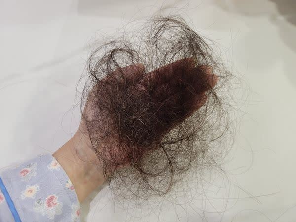 小彤透露化療恐怖副作用，不但嚴重落髮，而且被輕輕一碰就會瘀青。（圖／翻攝臉書）