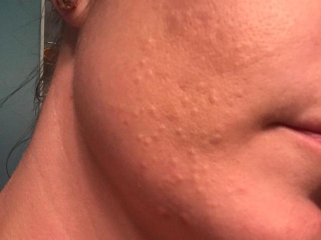 Folliculitis scarring and dark spots - Beauty Insider Community