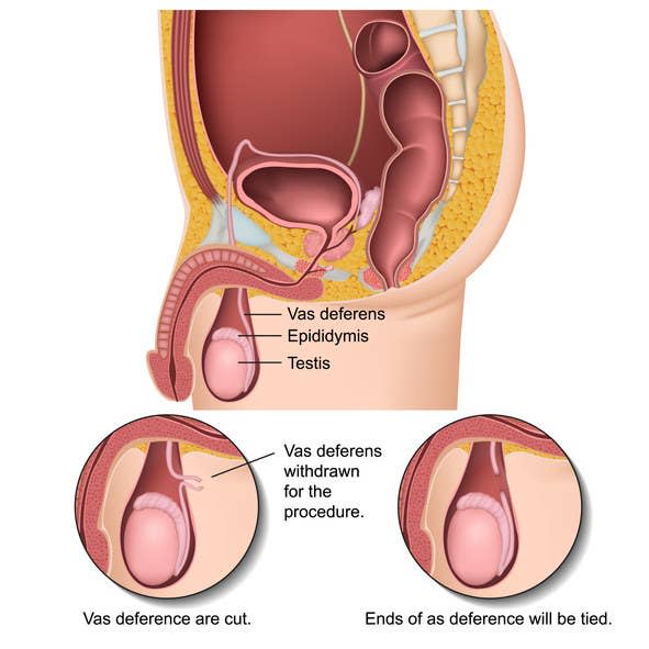 A chart detailing how a vasectomy is performed